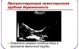 Прогрессирующая беременность — что это