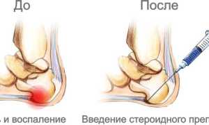 Укол в пятку при пяточной шпоре: препараты, техника проведения