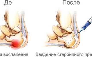 Укол в пятку при пяточной шпоре: препараты, техника проведения