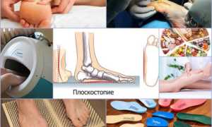 Лечение плоскостопия у взрослых