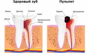 Признаки, симптомы и лечение пульпита зуба