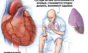Алгоритм и правила оказания неотложной помощи при острой сердечной недостаточности