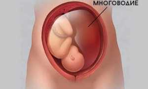 Многоводие — что это и как с этим бороться