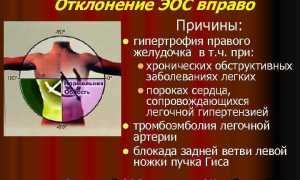 Что значит если ЭОС отклонена вправо?