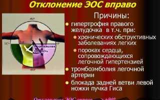 Что значит если ЭОС отклонена вправо?