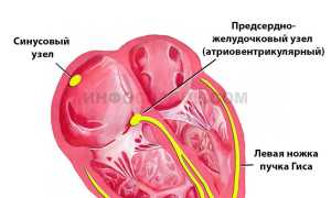 В каких случаях назначается кардиоверсия?
