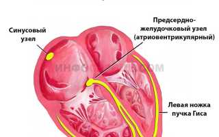 В каких случаях назначается кардиоверсия?