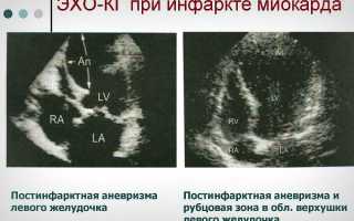 Что такое чреспищеводная эхокардиография (ЧП эхоКГ), насколько информативна и как часто назначают