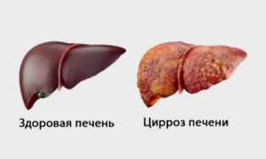 Цирроз печени на УЗИ