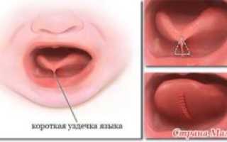 Подрезание подъязычной уздечки у ребенка