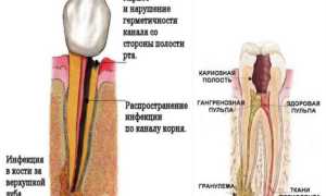 Что такое гранулема корня зуба и как ее вылечить