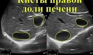 Как выглядят на УЗИ образования в печени и какие они бывают