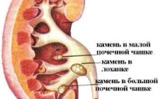Микронефролитиаз — начальная стадия мочекаменной болезни