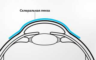 Контактная коррекция зрения – Показания и противопоказания