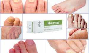 Микоспор от грибка