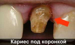 Почему болит зуб под коронкой и что с этим делать