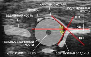 Что показывает УЗИ тазобедренного сустава у детей: когда норма, а когда стоит беспокоится