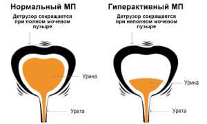 Причины детрузора мочевого пузыря: виды и классификация