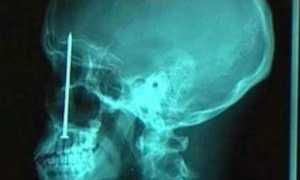 Что показывает рентген носовых пазух и как часто его можно делать