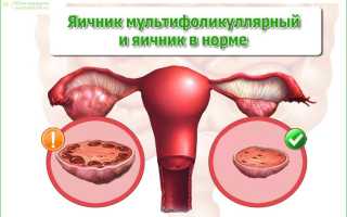 Мультифолликулярные яичники и беременность — возможно ли