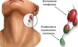 Подчелюстной лимфаденит: причины, стадии и симптомы, лечение, профилактика