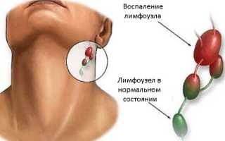 Подчелюстной лимфаденит: причины, стадии и симптомы, лечение, профилактика