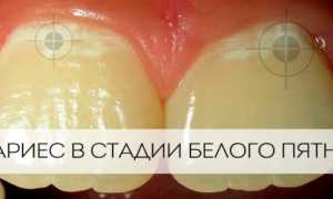 Кариес зубов: что это такое, виды, стадии, как лечить