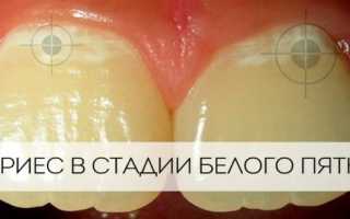 Кариес зубов: что это такое, виды, стадии, как лечить