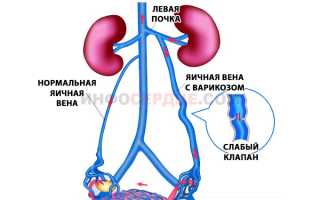 Насколько опасно варикозное расширение вен матки?