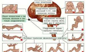 Менингит: как развивается, виды и проявления, диагностика, как лечить, профилактика
