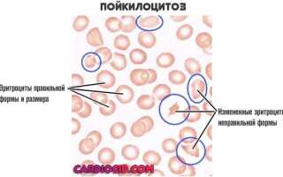 Из-за чего развивается пойкилоцитоз?