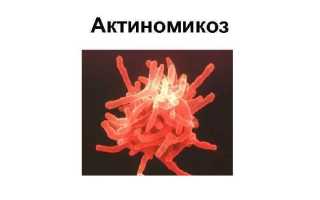 Актиномикоз при беременности