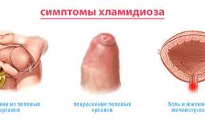 Резь и жжение при акте мочеиспускания у мужчин