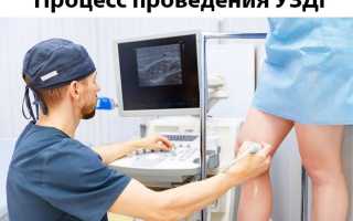 Когда назначают УЗДГ сосудов нижних конечностей?