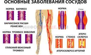 Как проводится профилактика возникновения тромбов в сосудах (тромбоза)?