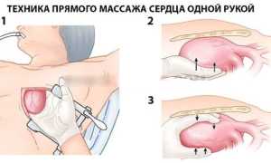 Особенности проведения прямого массажа сердца