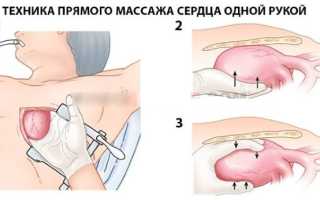 Особенности проведения прямого массажа сердца