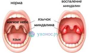 Промывание миндалин: суть процедуры, показания, способы, можно ли дома