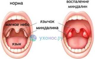 Промывание миндалин: суть процедуры, показания, способы, можно ли дома