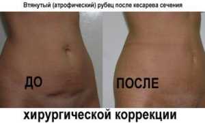 В каких случаях назначают экстренное кесарево сечение, показания