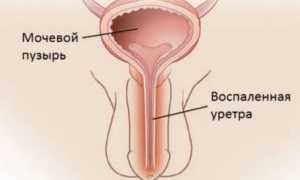 Народные методы лечения уретрита у мужчин и женщин в домашних условиях