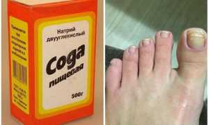 Сода против грибка ногтей на ногах — список самых эффективных средств
