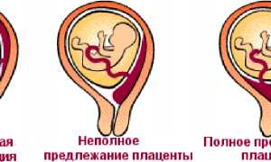 Что означает диагноз предлежание плаценты при беременности