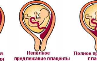 Что означает диагноз предлежание плаценты при беременности