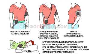 Что такое суточный мониторинг артериального давления (СМАД)?