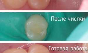 Герметизация фиссур зубов у детей и взрослых: что это, за и против