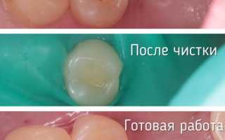 Герметизация фиссур зубов у детей и взрослых: что это, за и против