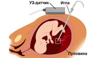 Кордоцентез при беременности: когда назначается, противопоказания