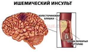 Что может провоцировать сужение сосудов головного мозга?