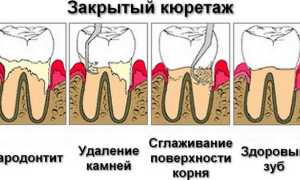 Что такое кюретаж пародонтальных карманов, методы кюретажа